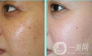 激光去曬斑多久恢復(fù),激光去曬斑術(shù)后護(hù)理