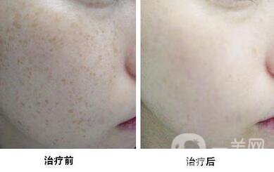 激光去曬斑價格,激光去曬斑*果