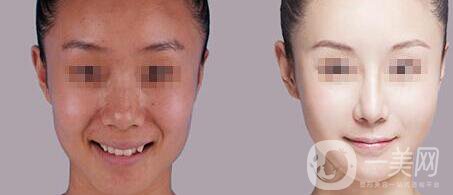 白瓷娃娃多少錢一次,白瓷娃娃術(shù)后護(hù)理