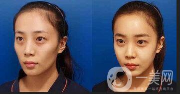 自體脂肪面部填充價格