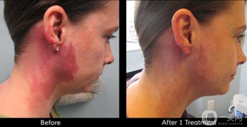 去紅色胎記留疤嗎？有哪些方法可以去胎記呢？