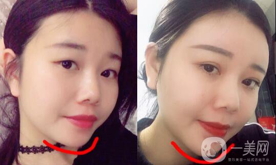 自體脂肪墊下巴恢復(fù)期是怎樣的？如何做好術(shù)后護(hù)理？