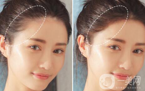 半*發(fā)際線的弊端有哪些？