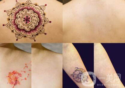 什么是激光去除紋身？洗紋身疼不疼？