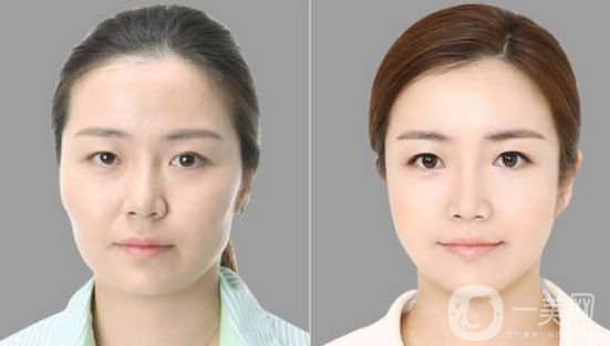 光纖溶脂雙下巴恢復(fù)圖 *果是*的嗎