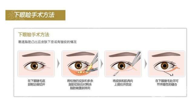 沃斯堡眼瞼手術怎么樣 有風險嗎？