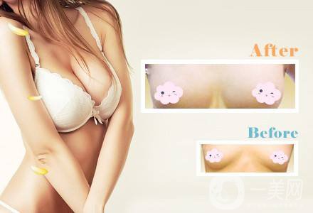 乳房提升怎么樣 隆胸手術時間是多久