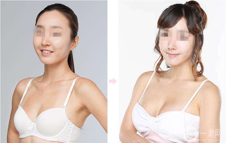 乳房提升怎么樣 隆胸手術時間是多久
