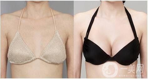 隆胸手術(shù)前應(yīng)該注意什么