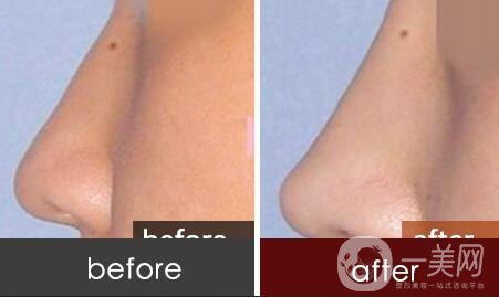 硅膠隆鼻價(jià)格