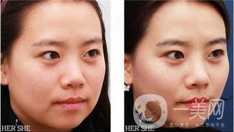 廣州做面部提升術*果