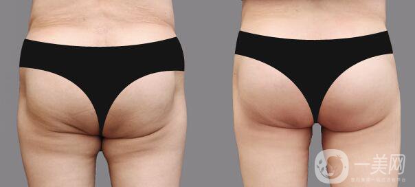 瘦臀吸脂術后*果