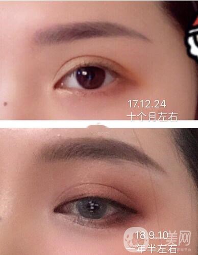 上海九院開眼角價格|*果測評