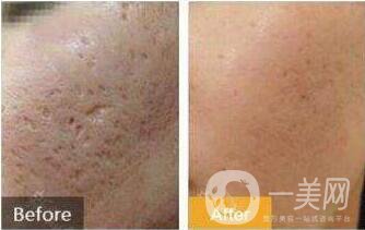 微針真的能去痘坑嗎 微針去痘坑*果好不好