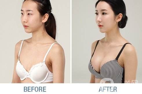 脂肪填充隆胸貴嗎 隆胸手術費用 手術方式有哪些
