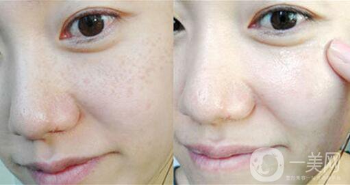 祛斑價(jià)格,祛斑貴不貴