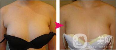 去副乳貴嗎,去副乳多少錢