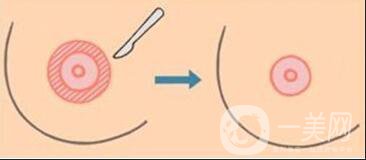 乳頭漂紅價格,乳頭漂紅多少錢