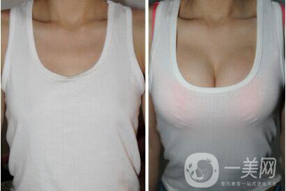 豐胸價格
