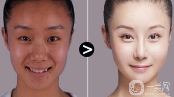 光子嫩膚價(jià)格,光子嫩膚*果