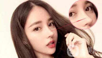 隆鼻哪種好 該如何選擇適合自己的方式？