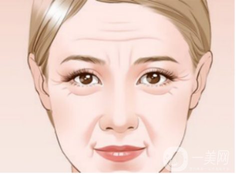 去皺多少錢 去皺費用是多少 祛皺的方法