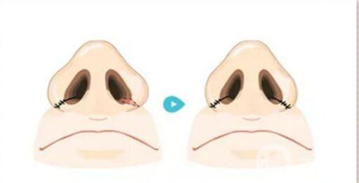 鼻翼縮小整形價(jià)格 鼻翼縮小多久恢復(fù)