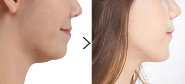 下巴增強有風(fēng)險嗎 手術(shù)要多久時間？