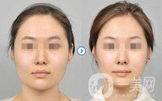 下頜角截骨貴嗎,下頜角截骨價格