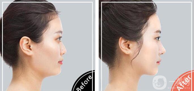 鼻頭縮小價(jià)錢