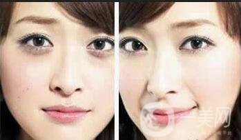 自體脂肪豐蘋(píng)果肌貴嗎 