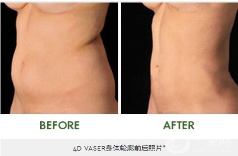 4D體輪廓吸脂術