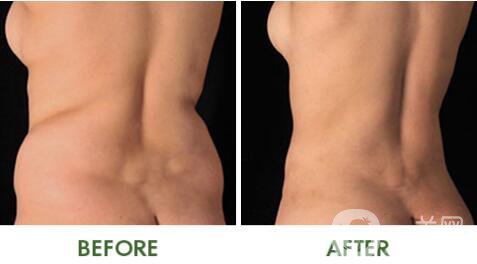 4D體輪廓吸脂術