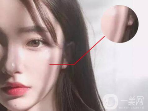 磨顴骨*果怎么樣 有什么風(fēng)險(xiǎn)嗎？