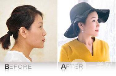 自體脂肪豐面頰貴嗎 豐面頰整形手術(shù)的費用