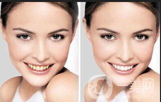 皓齒美白牙齒多少錢,皓齒美白牙齒費(fèi)用分析