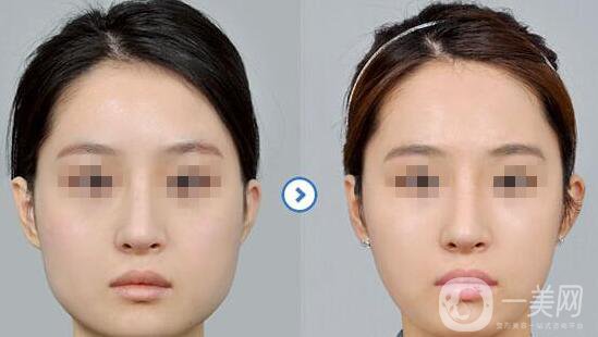 磨骨整形貴,磨骨多少錢