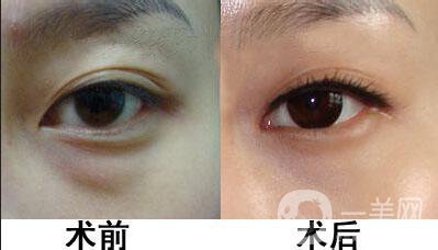 超聲法去眼袋價(jià)格,超聲法去眼袋術(shù)后護(hù)理