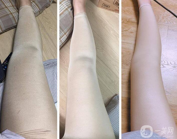 小腿吸脂的價格介紹附真人*果反饋