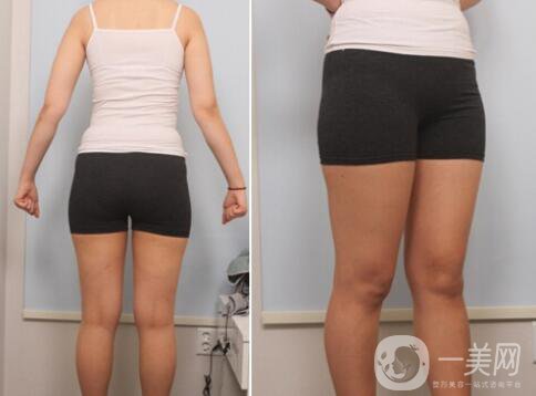 小腿吸脂價格,小腿吸脂真人*果反饋