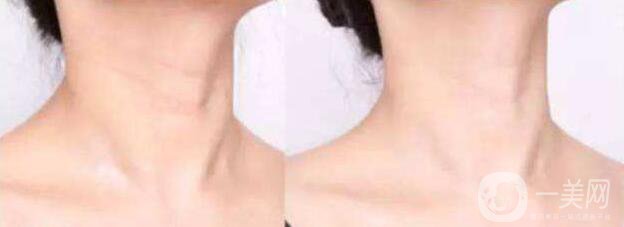 有頸紋怎么辦 調節(jié)頸紋的方法有哪些
