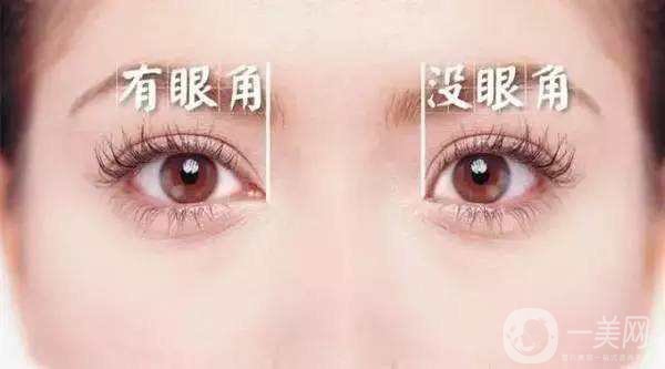 開(kāi)眼角手術(shù)圖怎么樣 開(kāi)眼角手術(shù)價(jià)格