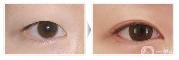 開(kāi)眼角手術(shù)圖怎么樣 開(kāi)眼角手術(shù)價(jià)格