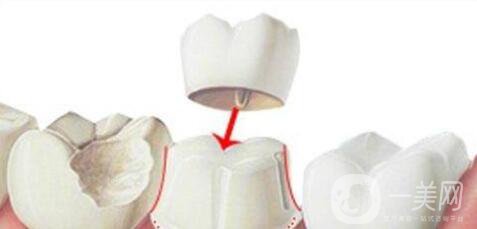 美容冠多少錢 美容冠*果好不好