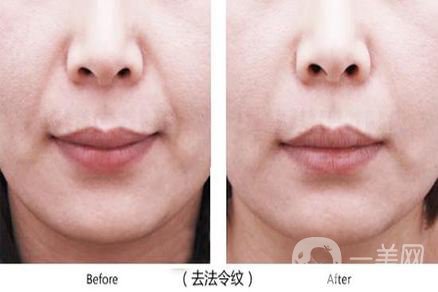 自體脂肪填充法令紋貴嗎 去法令紋的*果好不好