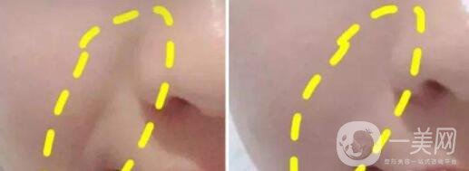 自體脂肪填充法令紋貴嗎 去法令紋的*果好不好