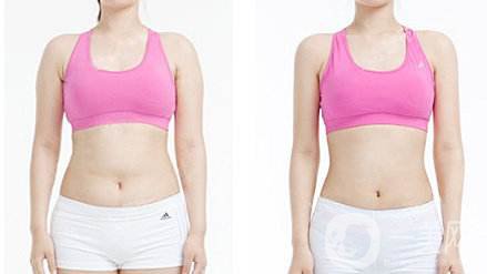 腹部吸脂手術價格 腹部吸脂手術危險嗎