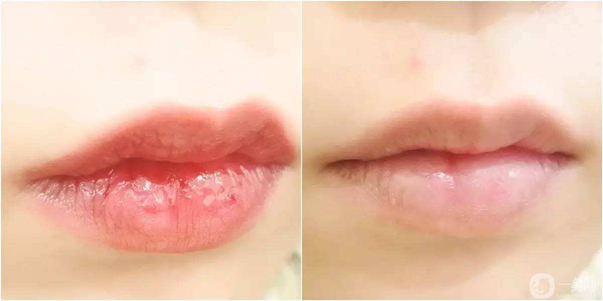 伏爾貝拉的作用是什么 伏爾貝拉*果好不好