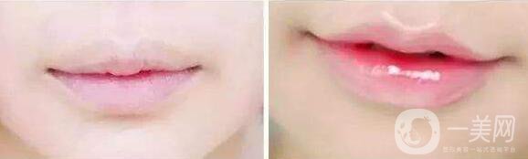 沃斯堡的長*減皺好不好 *果怎么樣?