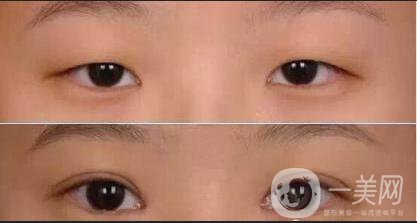 上瞼下垂多少錢,上瞼下垂術后護理